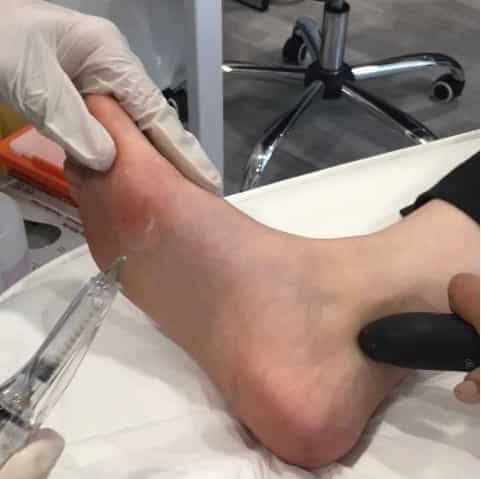 Dermal Fillers Putney