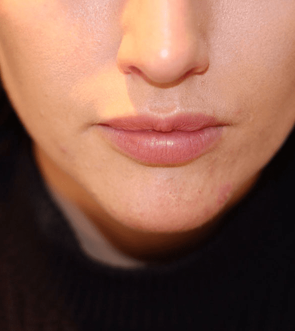 lip enhancement harley street
