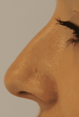 Non-Surgical Nose Job