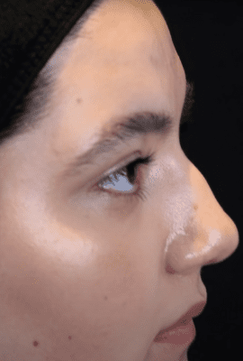 Non-Surgical Nose Job