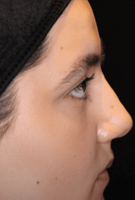 Non-Surgical Nose Job