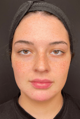 Cheek, Jaw and Chin Filler