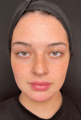 Cheek, Jaw and Chin Filler