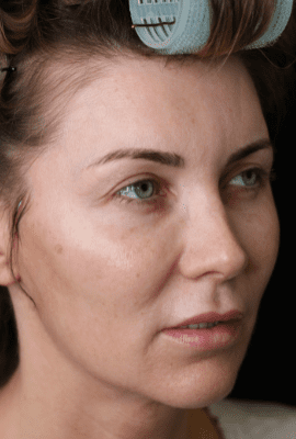 Cheek Filler