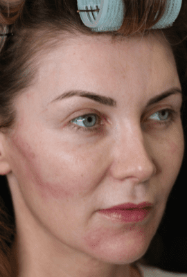Cheek Filler