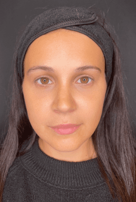 Cheek Filler