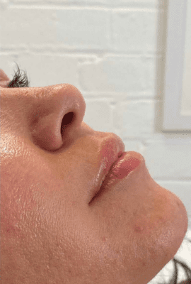 Lip Filler Kent