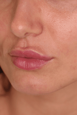 Lip Filler Kent
