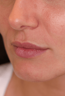 Lip Filler Kent
