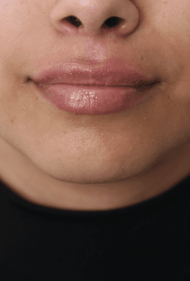 Lip Filler London