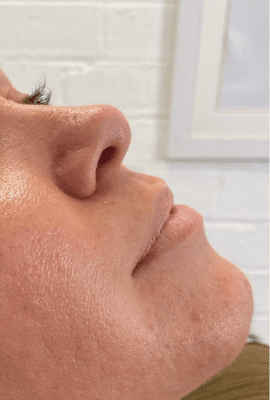Lip Filler Kent