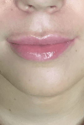 Lip Fillers.