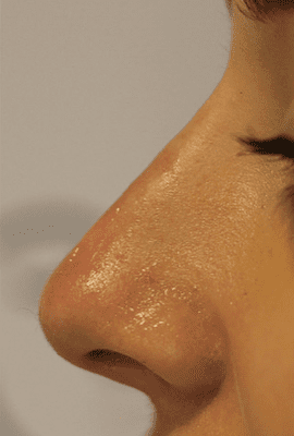 Non-Surgical Nose Job