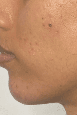 Chin Filler London