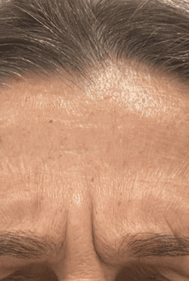 Botox London