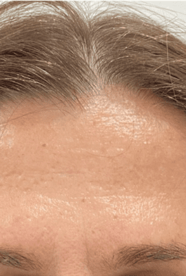 Botox London