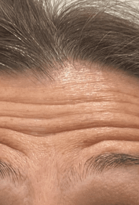 Botox London