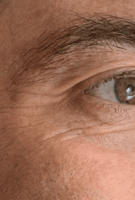 Male Botox London