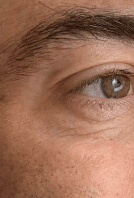 Male Botox London