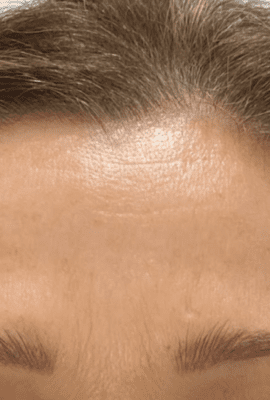 Botox Kent