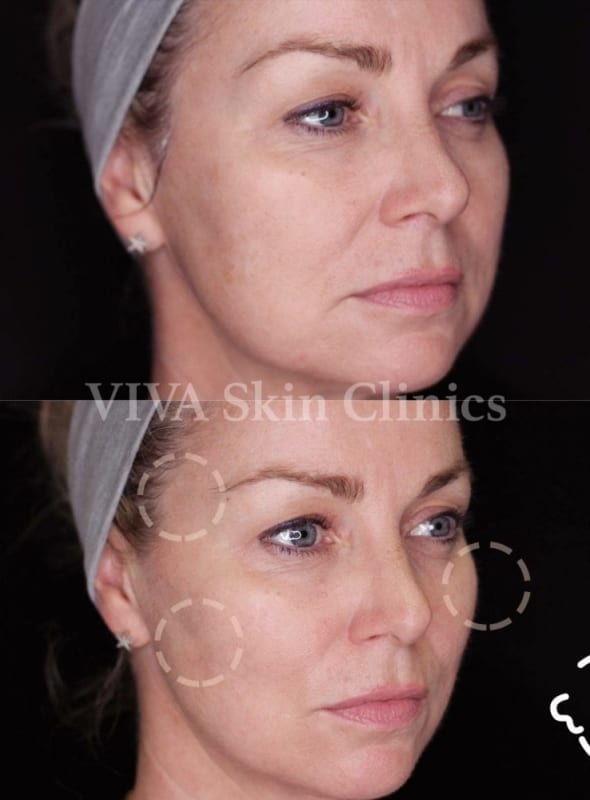 VIVA Skin Clinics 3D Face Refresh results