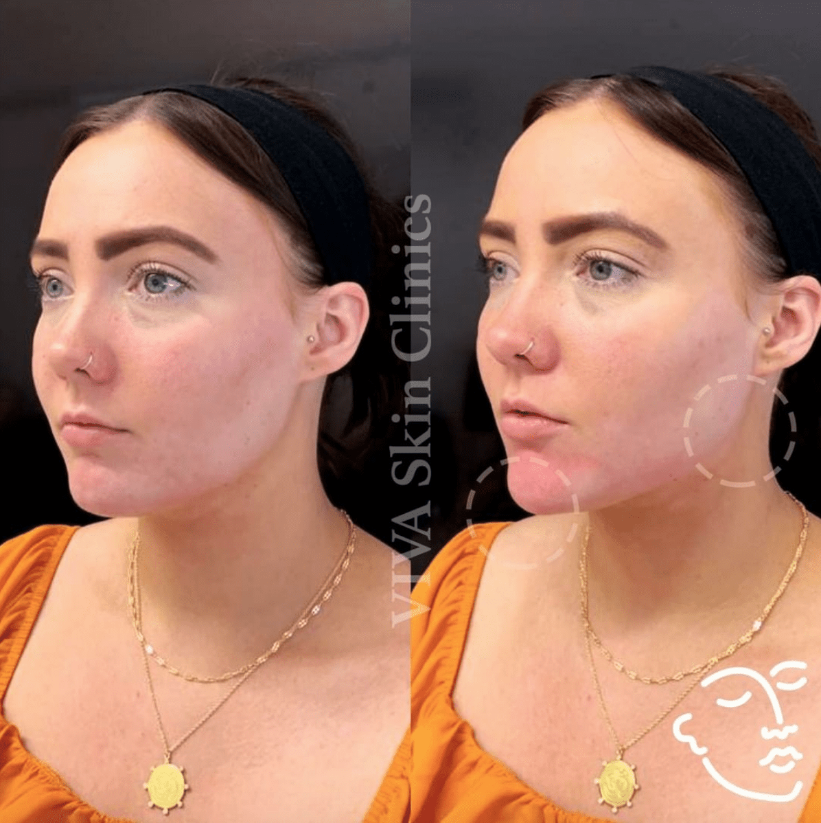 Jawline female strong Surgery for