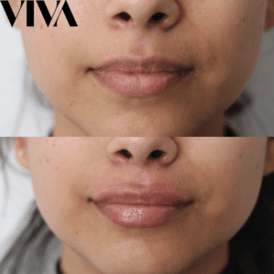 lip fillers, before and after lip fillers