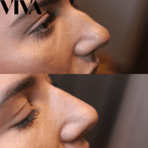 Non surgical nose job pictures